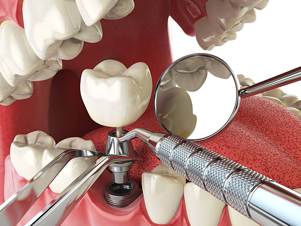 Best Emergency Root Canal Treatment in West Simsbury, CT
